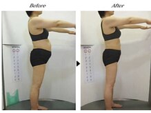 ビューティークリニックコダマ 宮崎本店/【1か月コース】F.N様（45歳）