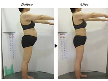 ビューティークリニックコダマ 宮崎本店/【1か月コース】F.N様（45歳）