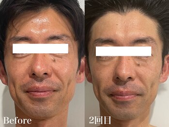 クリア(CLEAR)/小顔美整顔