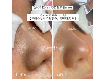 ヴィディトゥ(vidyto)/人気毛穴改善コース＋エンビロン