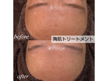 シュカ(Shuka)/ハーブピーリング