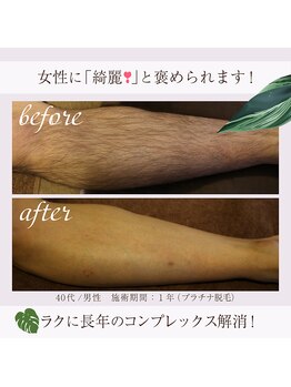 ラフラフ(Laf Laf)/脚脱毛