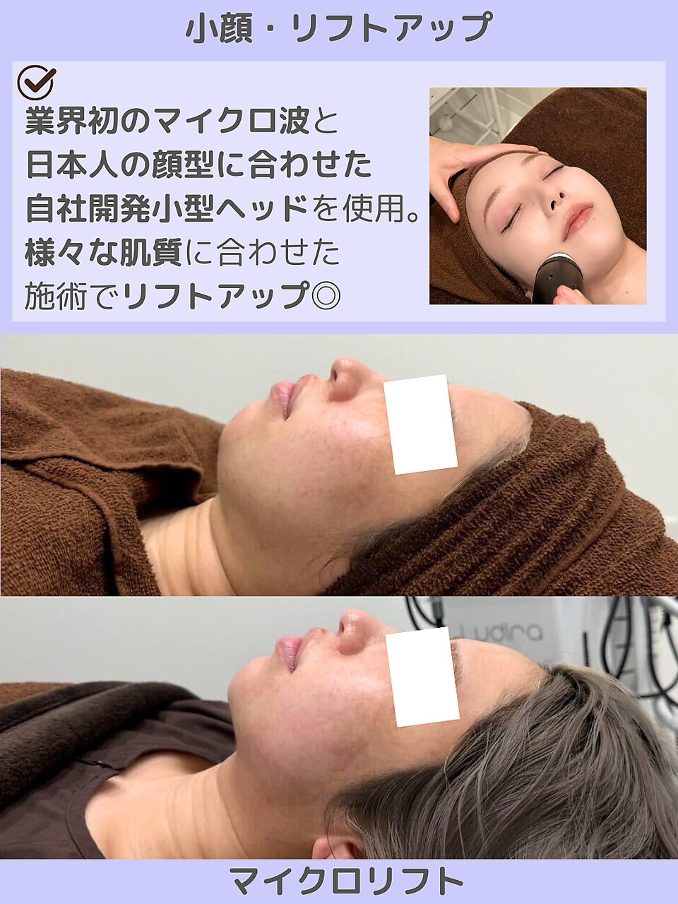 【二重あご/顔の脂肪】すっきり引き締まった小顔へ｜マイクロ波リフト
