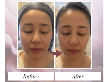 トータルビューティー筋膜ケアサロン カンスタイル(Kanstyle)/IPL光フォト