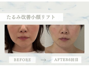 ソラ(Sola)の写真/即効小顔へ！たるみ改善にも◎超音波×高周波のいいとこ取りマシンで理想のフェイスラインへ☆