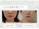 ソラ(Sola)の写真/即効小顔へ！たるみ改善にも◎超音波×高周波のいいとこ取りマシンで理想のフェイスラインへ☆