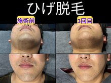 イデアル(ideal)/ひげ脱毛（20代）