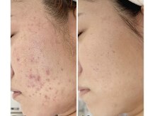 スムース イー(Smooth+E)/ニキビケアで悩み改善しましょう