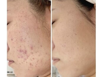 スムース イー(Smooth+E)/ニキビケアで悩み改善しましょう