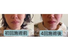 すわ鍼灸整骨院/【口もと】施術継続の効果♪
