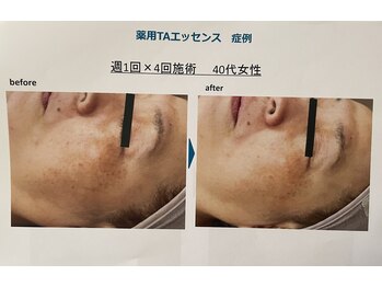 ルカシエ(Le Cacie)/40代女性/シミ改善