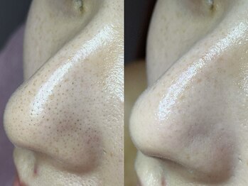 エミュ(emu)/毛穴の黒ずみ無かったことに