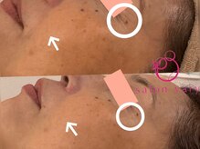 サロンヴェアリー 広尾(salon vary)/しわ、たるみ、毛穴悩みに
