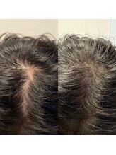 アネモネ(ANEMONE)/プロセル頭皮トリートメント