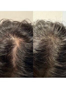 アネモネ(ANEMONE)/プロセル頭皮トリートメント