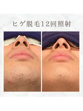 ボゴス(BOGOSS)/ヒゲ脱毛12回照射