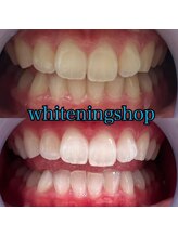 ホワイトニングショップ 武蔵小杉店/武蔵小杉ホワイトニング美白ケア