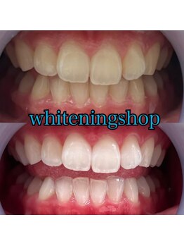 ホワイトニングショップ 武蔵小杉店/武蔵小杉ホワイトニング美白ケア