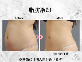ラクナ(RAKUNA)/お腹の脂肪冷却/ぽっこりお腹