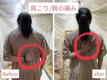 活法術 福岡整体院/肩の痛み、手が後ろに回らない