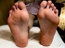 ビサンテ サロン/足裏のお悩み角質,たこ＆魚の目1