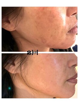 モゼ(moze)/ハーブピーリング