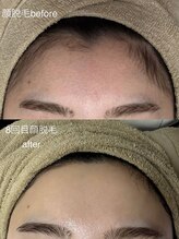 サロンドジェシカ(salon de Jessica)/顔脱毛 シェービング付 
