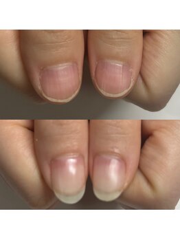 マニュコクーン(ManuCocoon)/爪育成 深爪 巻き爪 大阪