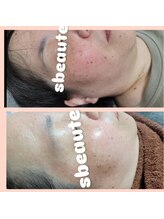エスボーテ(sbeaute)/肌別ピーリング