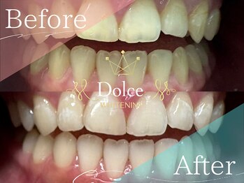 ドルチェ(Dolce)/ビフォーアフター