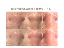 アルッカ(Arukka)の雰囲気（汚れをしっかり浮かせて吸引した後に、フェイシャル脱毛をプラス）