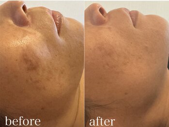 グレイティア(gratia)/ララピール2回施術後