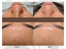 アン ビューティー(ann beauty)/施術1回【症例写真】30代