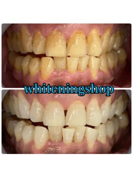 ホワイトニングショップ 武蔵小杉店/武蔵小杉ホワイトニング美白ケア