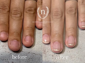 ネイル自爪育成