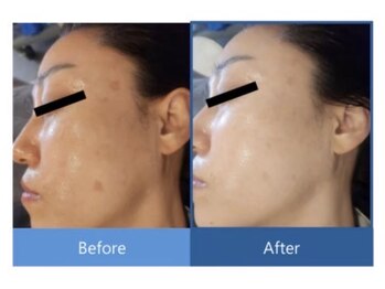 シアビューティーサロン(Cia)/くすみ改善・透明感UP