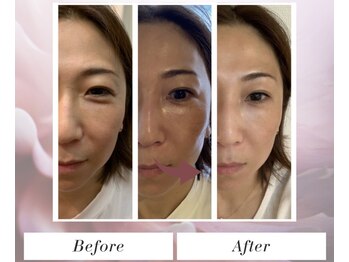 トータルビューティー筋膜ケアサロン カンスタイル(Kanstyle)/IPLフォト.ヒト幹細胞導入