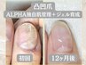 【爪変形】凸凹爪モニター募集　90分 通常1回¥16,500 → ¥11,000 オイル付
