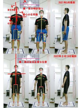 姫路なごみ整体院 なごみ鍼灸院/改善例（座骨の痛みコムラ返り）