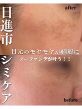 アールエム ボーテ(RM beaute')/プラズマ＋シミケア