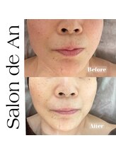 サロン ド アン(Salon de An)/１回の施術でも効果あり！！