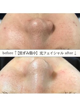 アースコアフュールボーテ 佐野新都市店(EARTH coiffure beaute)/#光フェイシャル#美白#美肌