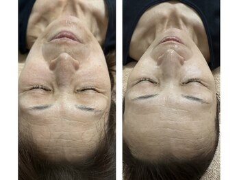 リバイセリー(Revicelly)/年齢によるお悩み解決◎