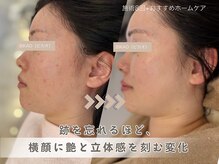 ビカオ(BIKAO)/ハーブピーリング