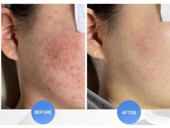 ツヤハダコガオ 千葉店/before⇒afterハーブピーリング