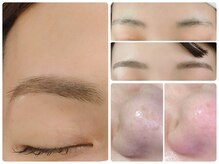 トータルビューティ ノイド(Noid)/小鼻コース＋美眉毛WAX脱毛