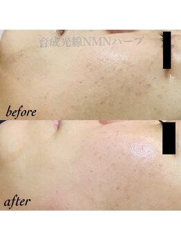 ピアーノ(PIANO)/エルモサハーブピーリング