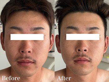 クリア(CLEAR)/小顔美整顔