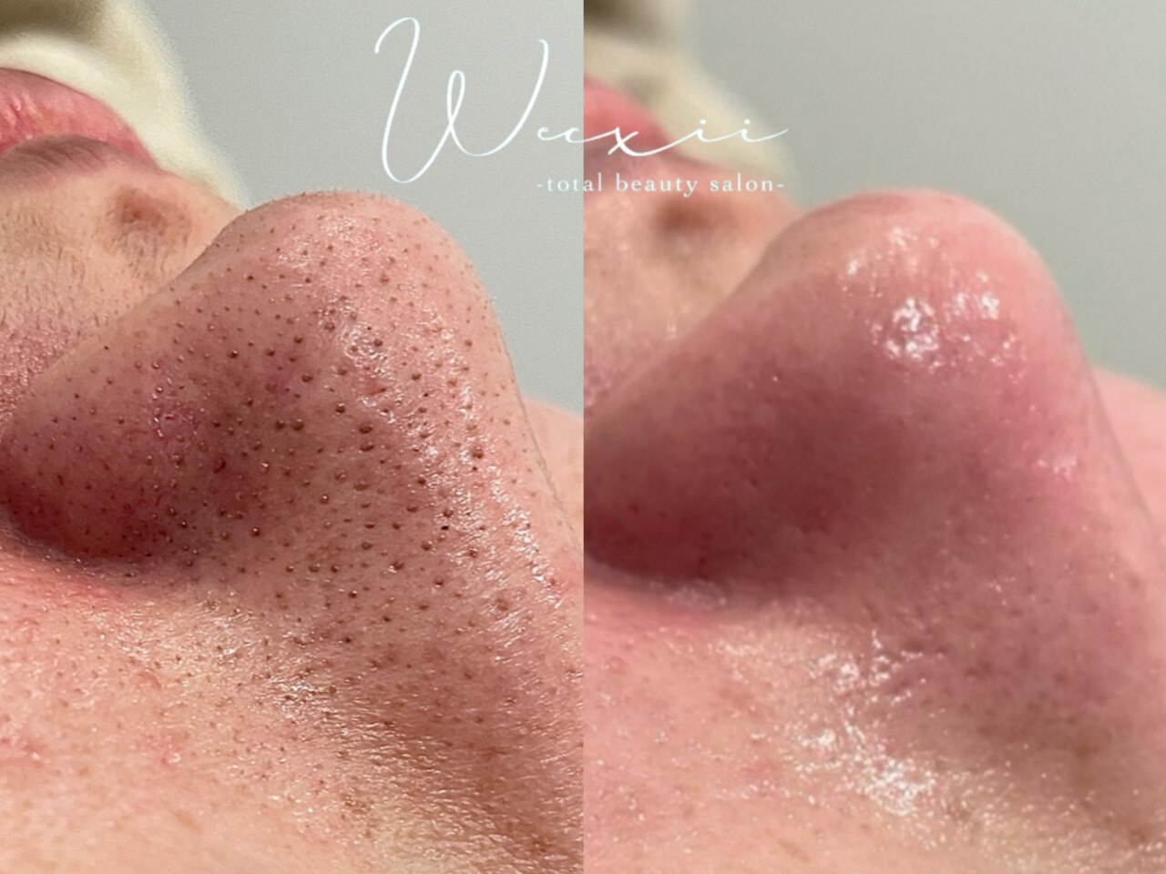 肌質改善エステサロン♡ VOSサロンケア 【肌質改善】 | 春日井市【本気の肌改善】シミ