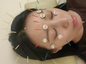 はり灸心音の写真/目ぱっちり！眼精疲労を鍼灸で解決★スマホ疲れやPCによる目の疲れ・首肩頭コリに◎